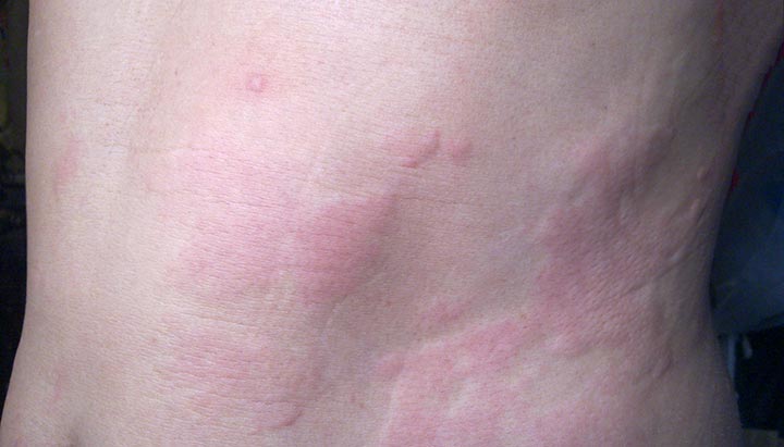 Red, raised welts from chronic hives on a person’s skin. 