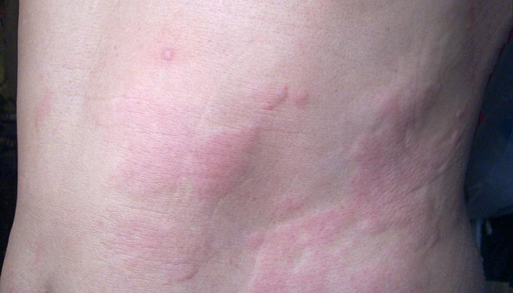 Itchy lupus rash on legs: Pictures, symptoms, and more