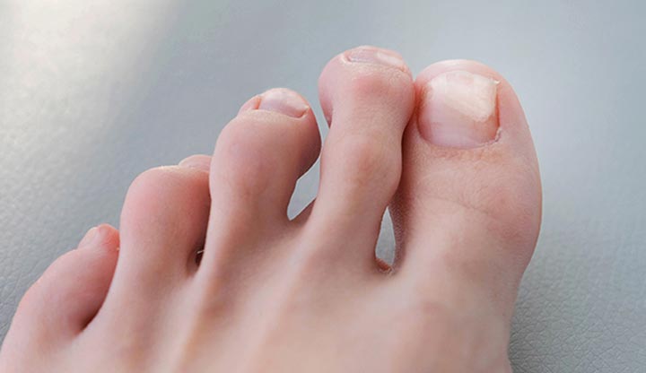 Onycholysis on the hallux (big toe) of a left foot. The nail has lifted about halfway off the nail bed.