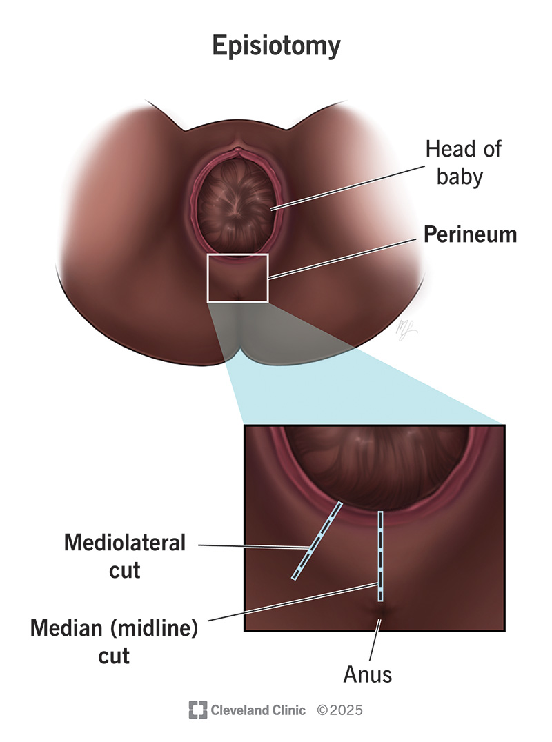 A vertical (median) cut from the vagina that extends toward the anus and an angled (mediolateral) cut
