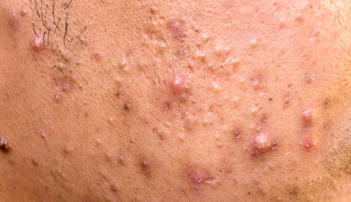 Red and inflamed acne papules on an area of skin.