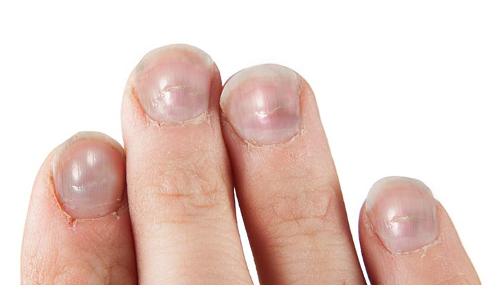 Dried Blood Under Fingernail: What to do