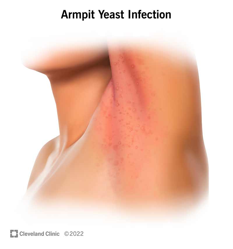 The most common symptom of an armpit yeast infection is a bright red rash in the skin folds of your armpit. You may also see small, pimple-like spots.
