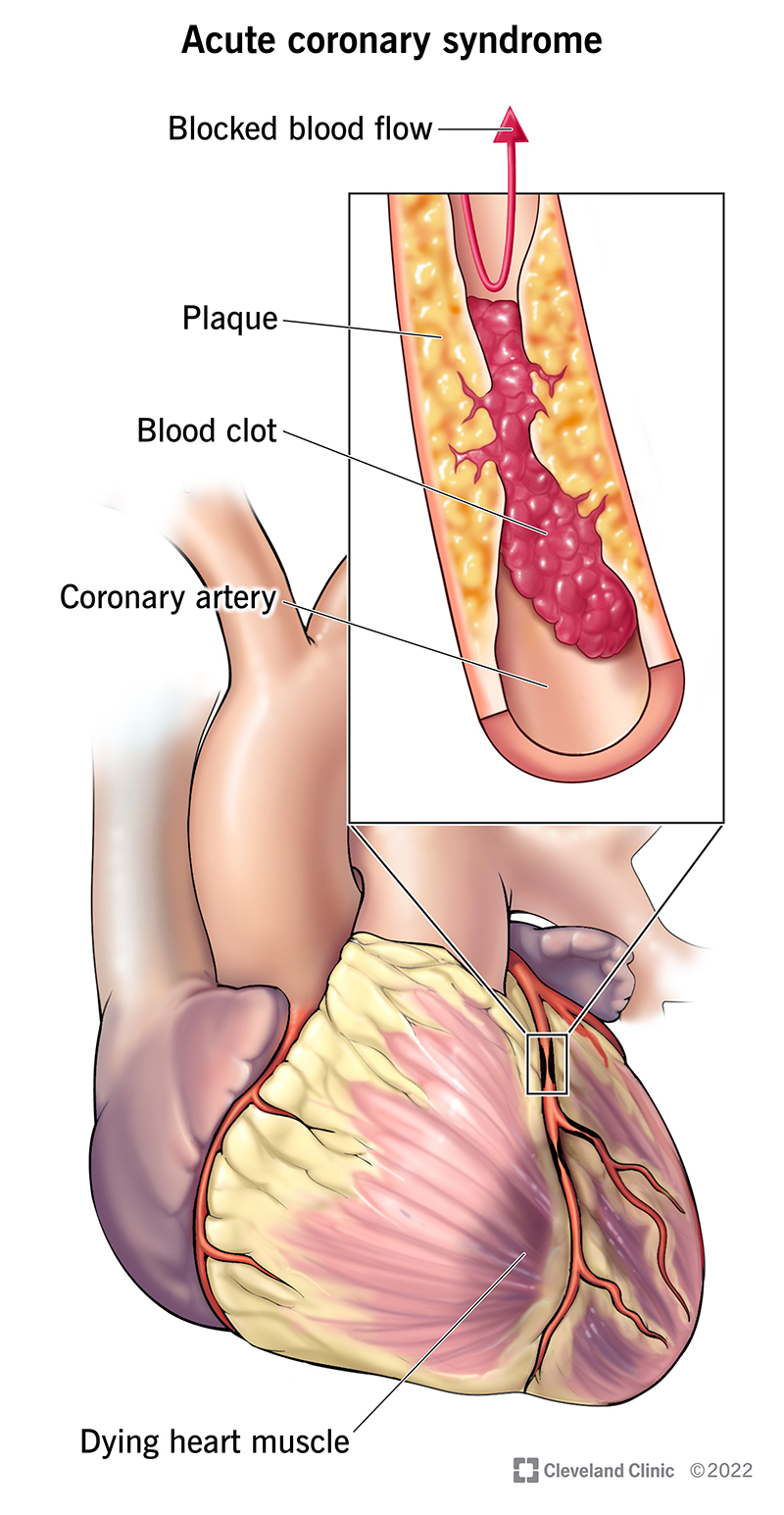 In coronary artery syndrome, plaque narrows the coronary artery and a blood clot forms, preventing oxygen from getting to the heart muscle, which begins to die.