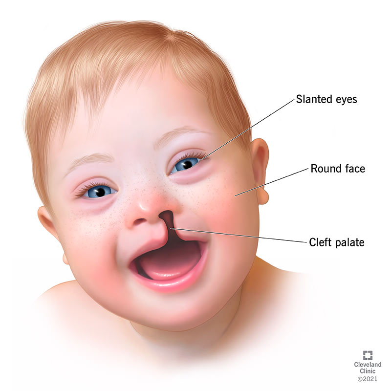 people with translocation down syndrome