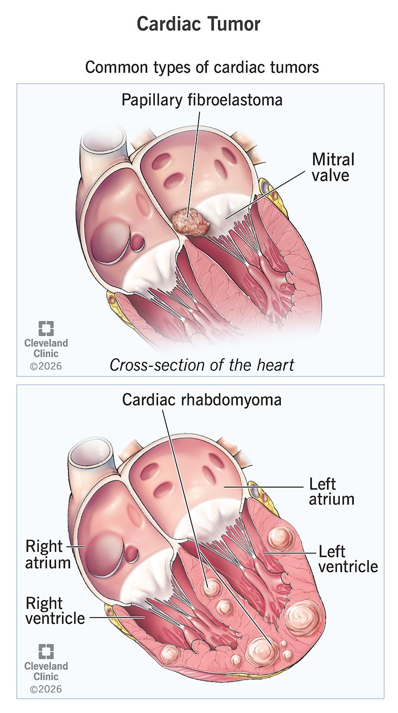 Anatomy of the heart with cardiac tumors