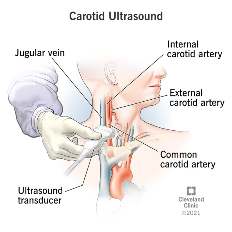 Carotid ultrasound to examine blood flow through the carotid arteries.