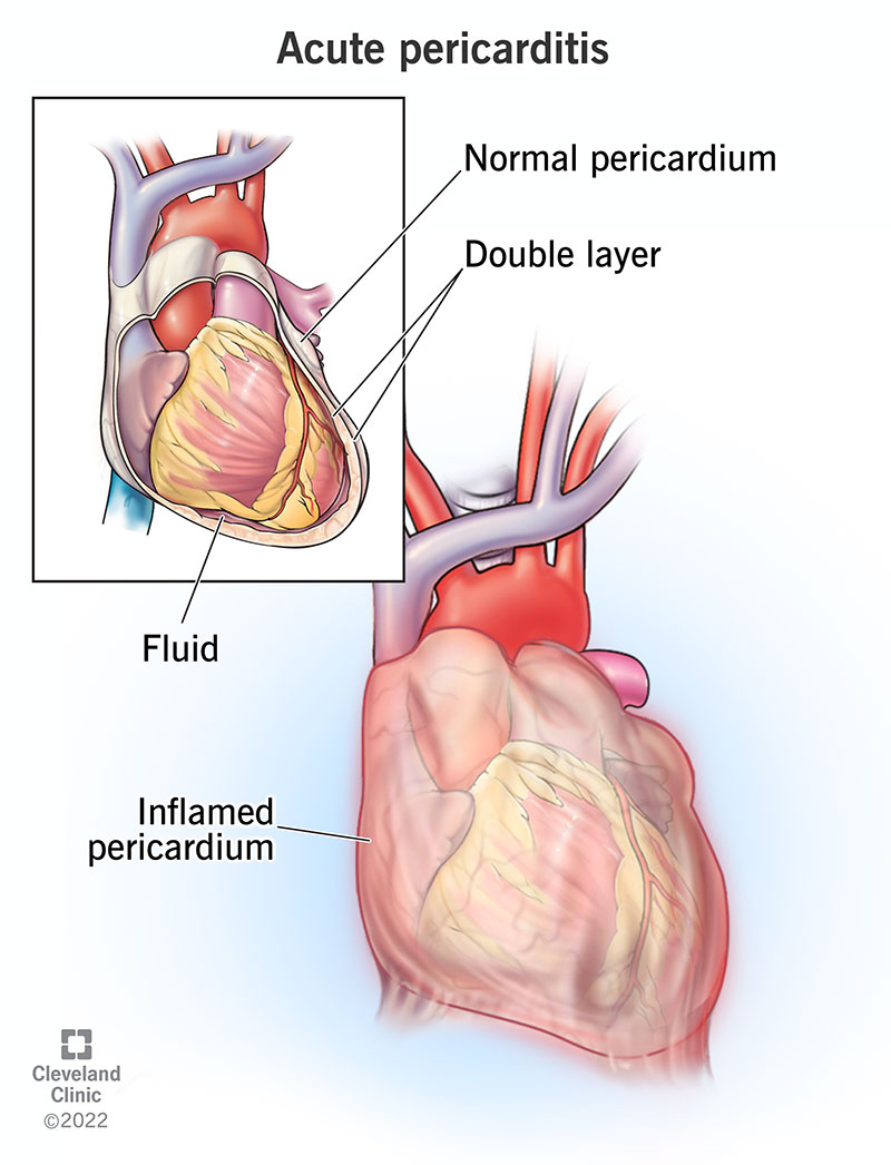 Acute pericarditis is inflammation of the pericardium