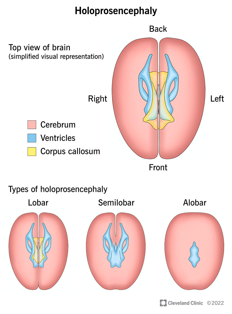 Types of holoprosencephaly include lobar (almost complete division), semilobar (partial division) and alobar (no division at all).