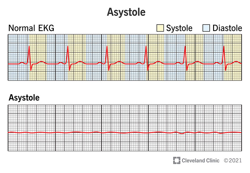An EKG of a heart with asystole shows a flat or nearly-flat line, meaning there's little or no electrical activity.