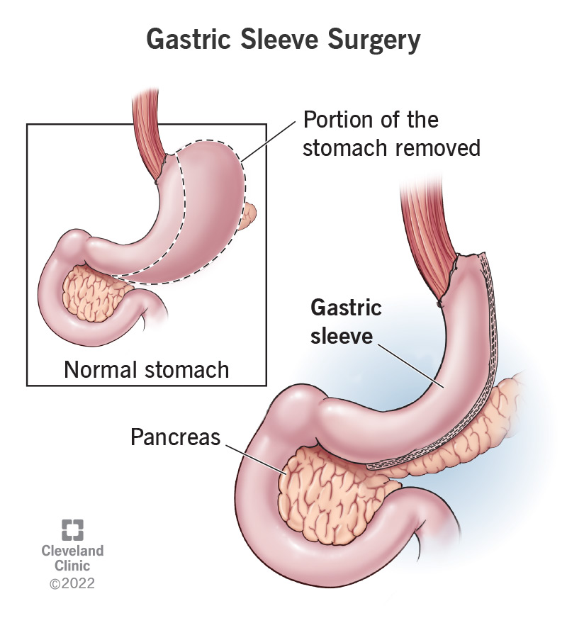 Stomach with sleeve gastrectomy