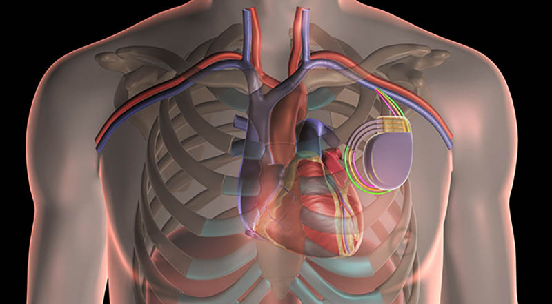 Cardiac resynchronization therapy uses a pacemaker to restore a normal heart rhythm.