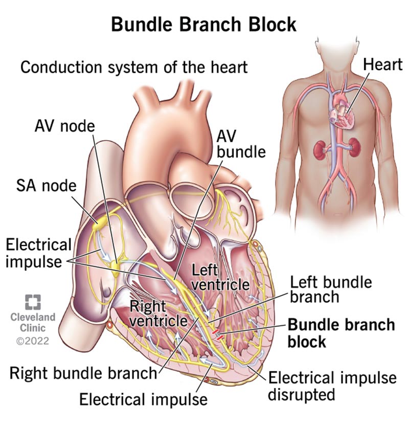 Diagram of the conduction system of the heart, with the disruption of a bundle branch block.