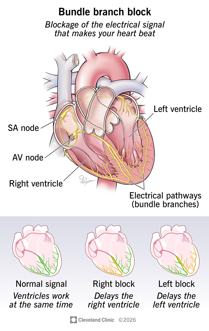 Different kinds of bundle branch block in the heart