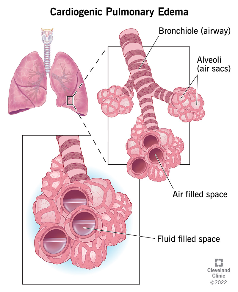 Illustration of cardiogenic pulmonary edema, an accumulation of extra fluid in your lungs.
