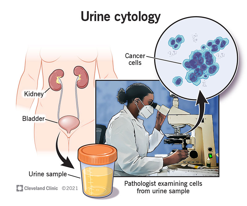 Urine cytology results