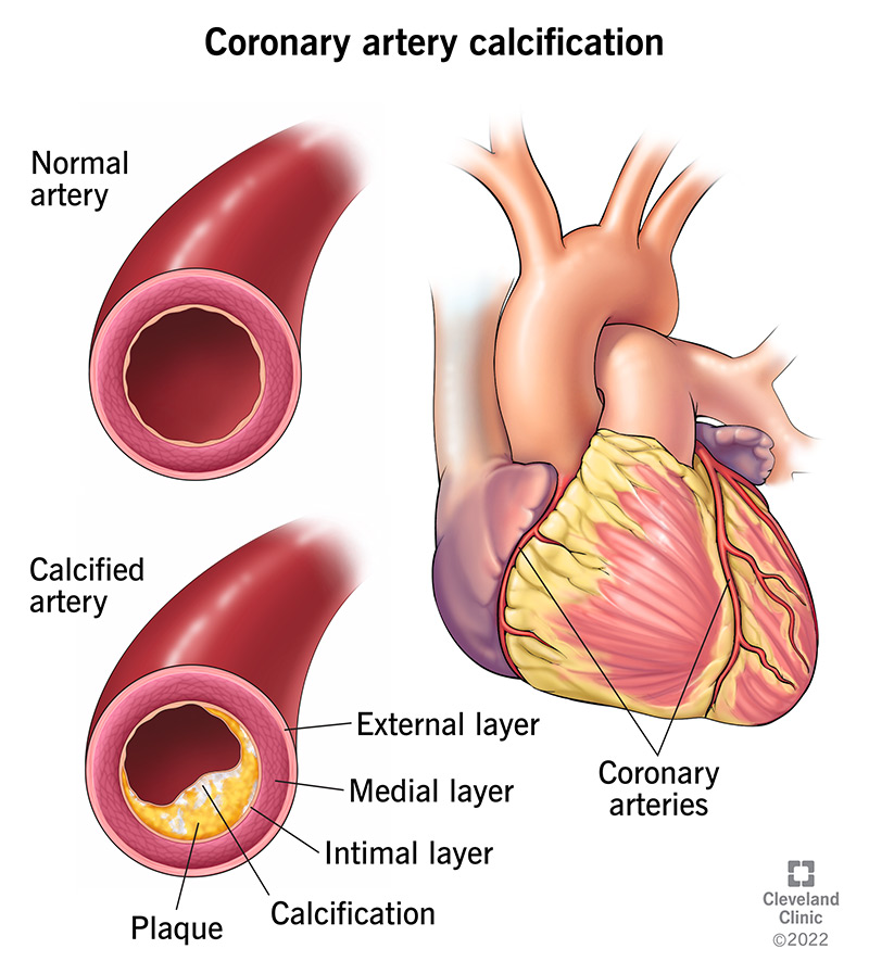 Calcium buildup causing coronary artery calcification.