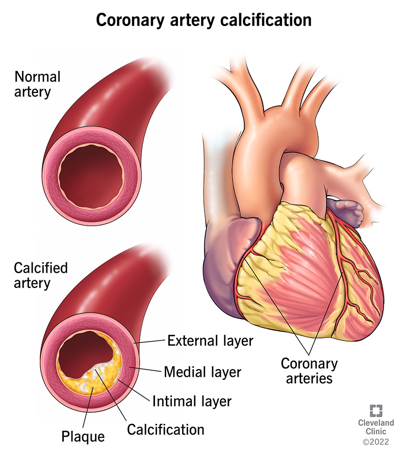 coronary artery disease treatment