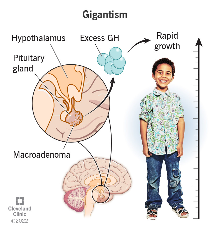 Gigantism occurs when a tumor on a pituitary gland produces high levels of growth hormone, causing a child to grow very tall.