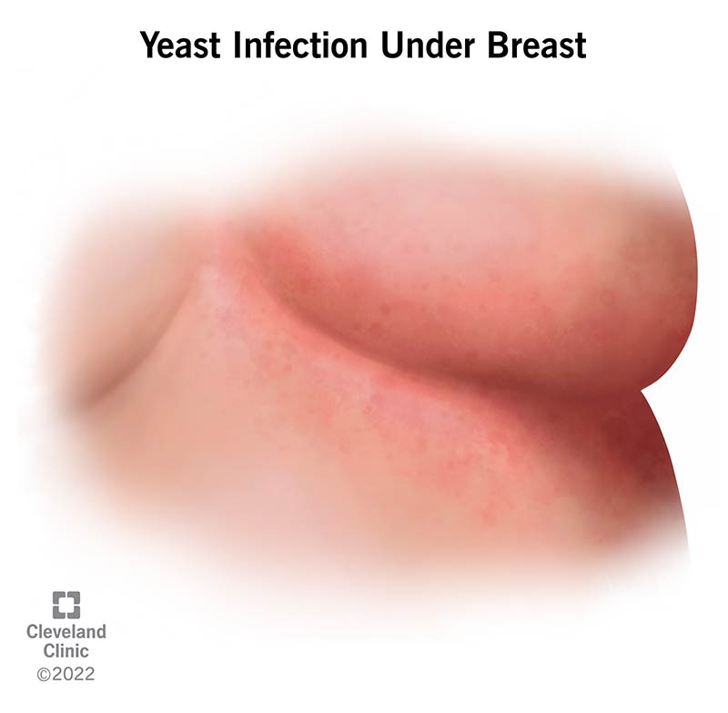 A yeast infection under your breasts looks like a bright red rash that may also appear on your torso where your breast skin touches your chest.