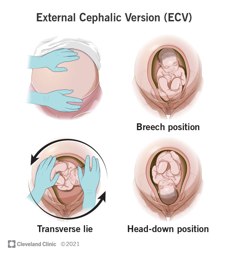 Provider rotates breech or transverse baby to a head-down position.