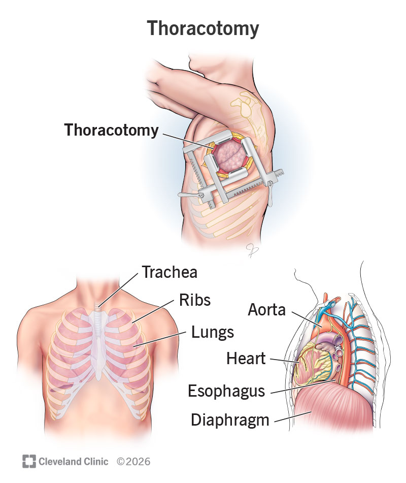 A thoracotomy is an open surgery involving a cut between your ribs to operate on an organ in your chest