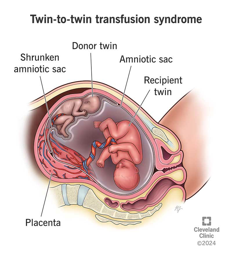 Identical twins with twin to twin transfusion syndrome inside the uterus.