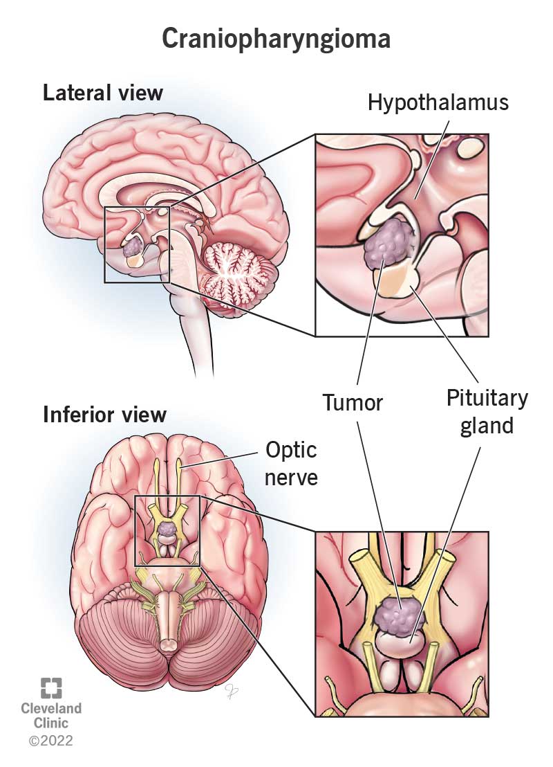 Top left lateral view (view from the side) brain showing a craniopharyngioma (benign tumor) near pituitary gland. Top right . Close up of tumor near pituitary gland (lower right) and hypothalamus (upper right). Bottom left inferior view (view from behind) brain showing optic nerve above pituitary gland. Bottom right close up of tumor above pituitary gland.