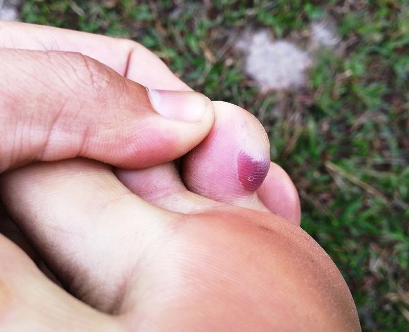Blood blisters fill with blood instead of clear fluid. They’re most common on your hands, fingers, feet and toes.