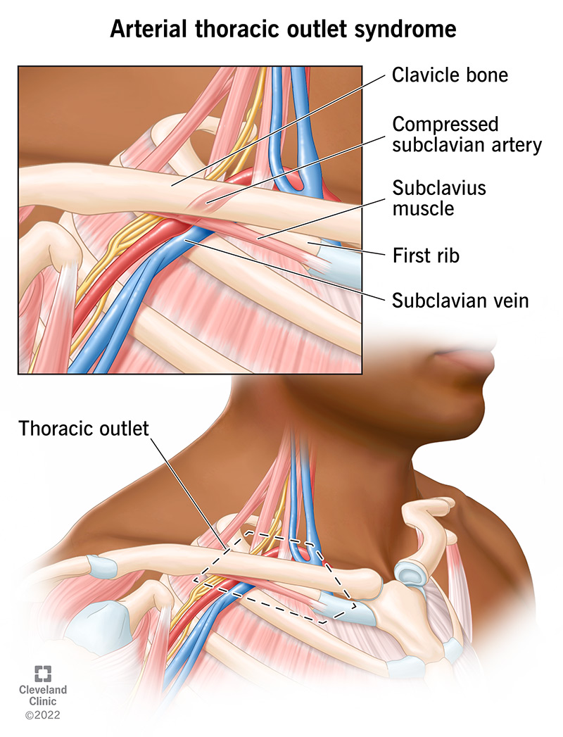 In an arterial thoracic outlet syndrome, the subclavian artery is compressed between the clavicle bone and first rib.