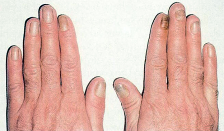In a person with yellow nail syndrome, the nails have turned yellowish-brown and are separating from the nailbed.