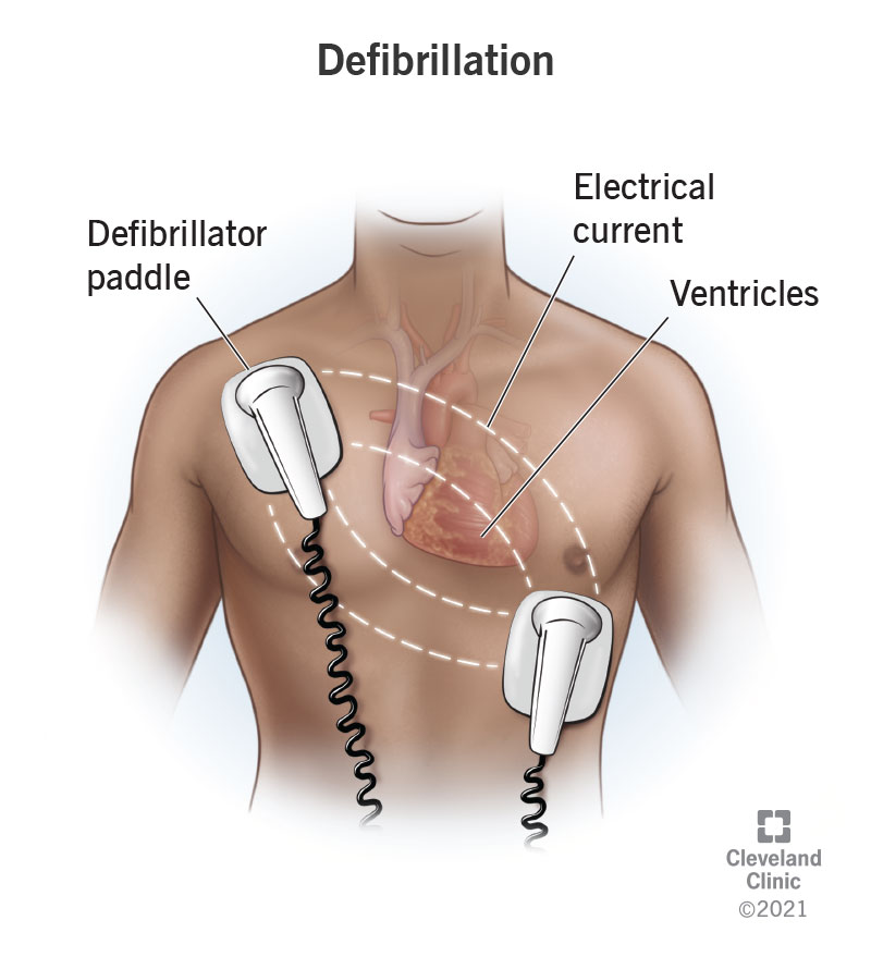 Use of a defibrillator to restore a normal heart rhythm.