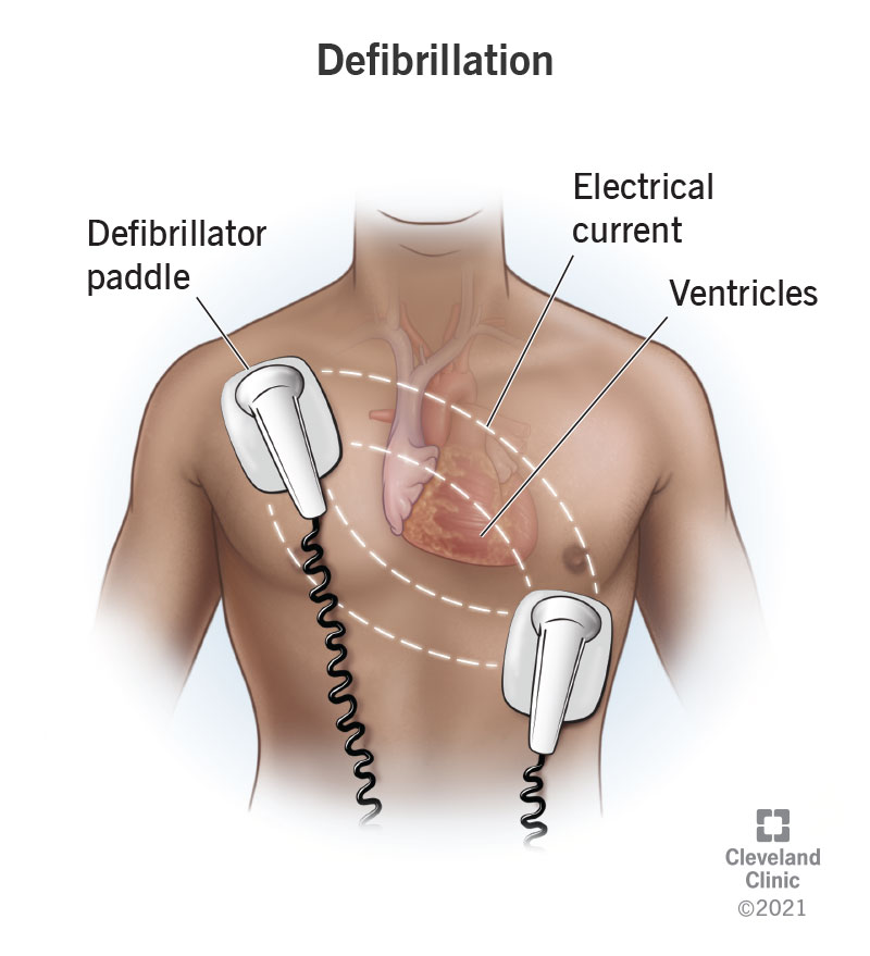 What is Defibrillation Used For?