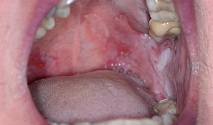 Pemphigus sores inside of a person’s mouth. 