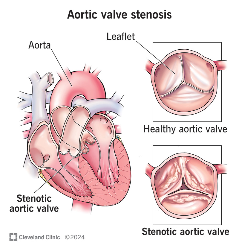 Aortic stenosis in your aortic valve means your blood can’t move through the narrowed valve easily.