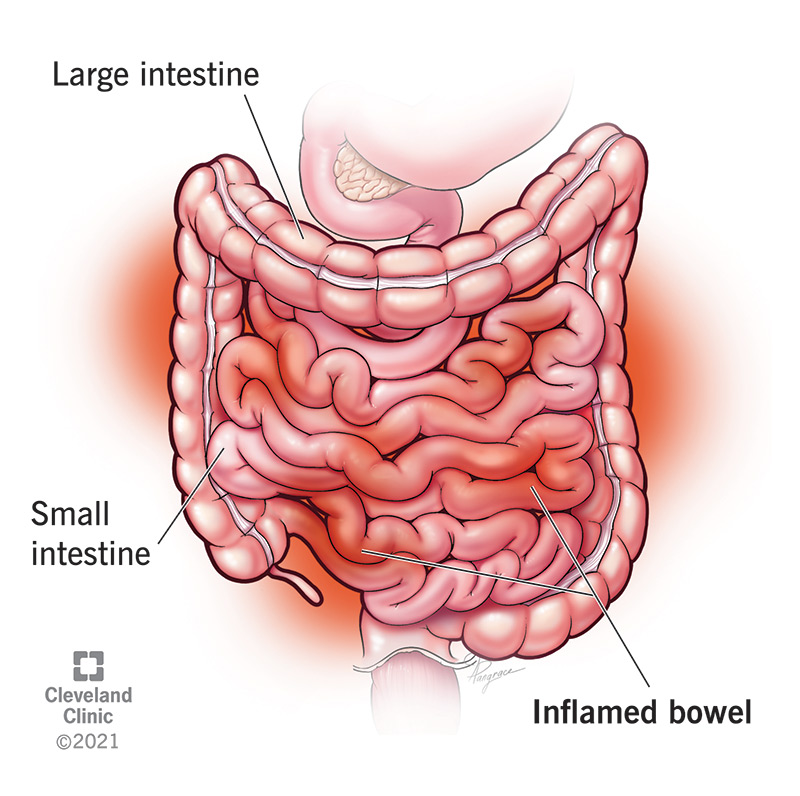 Enteritis is inflammation of the small intestine.