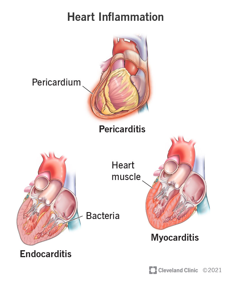 Pericarditis, endocarditis and myocarditis are types of heart inflammation.