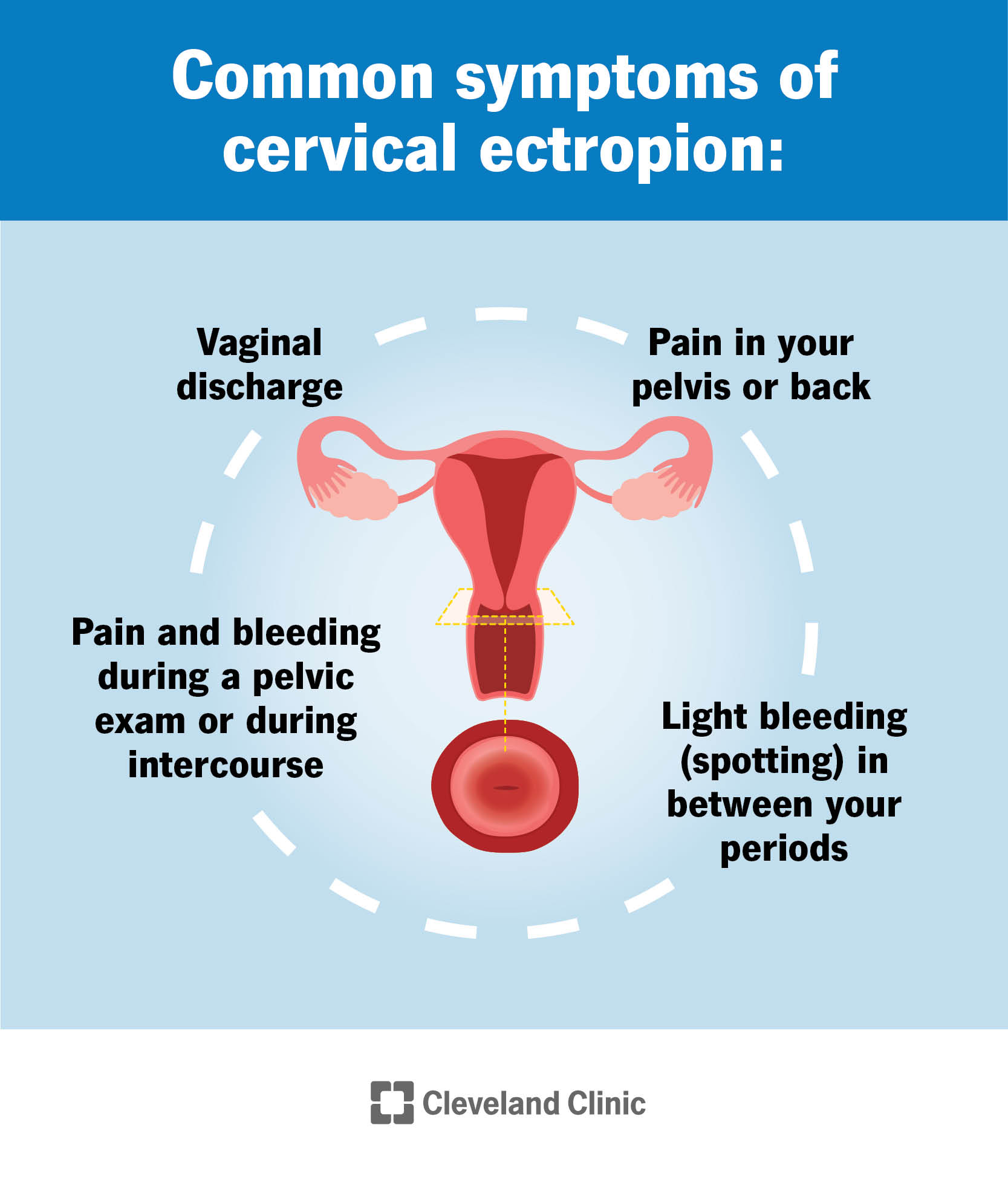 Reproductive system of a person assigned female at birth, with a focus on the cervix. Accompanying text summarizes the common symptoms of cervical ectropion.