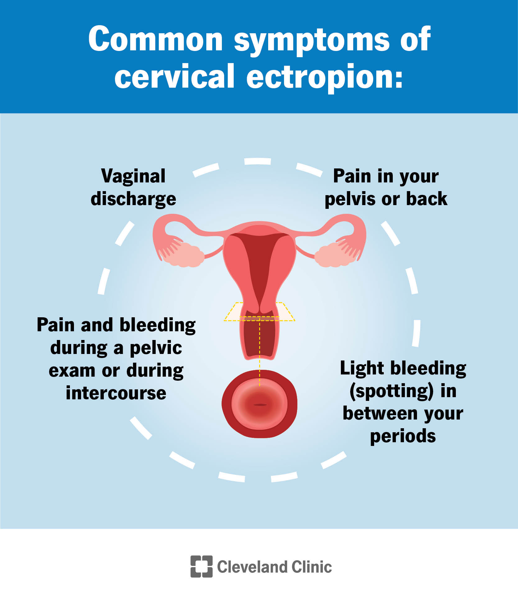 Possible causes of vaginal spotting (bleeding) between periods