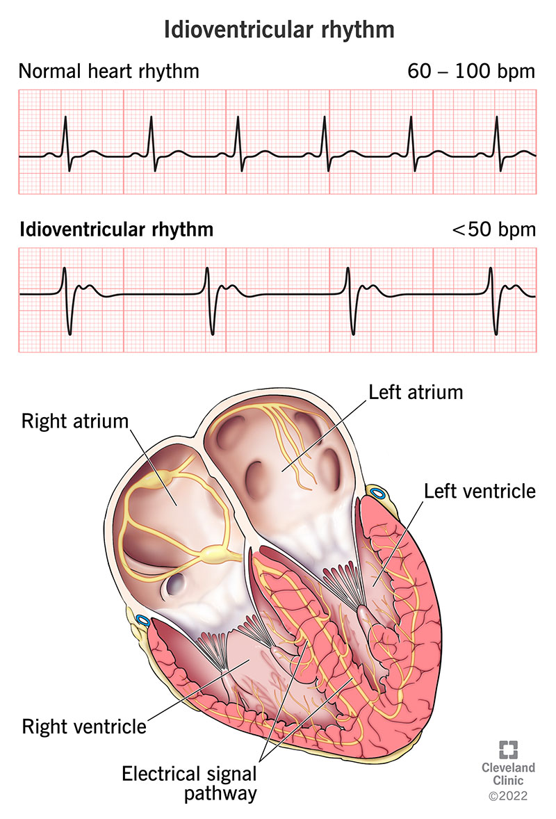 An idioventricular heart rhythm is a slow ventricular rhythm, usually at a rate of less than 50 beats per minute.