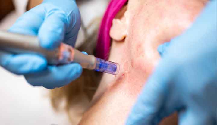 A healthcare provider performs microneedling on a woman’s neck.