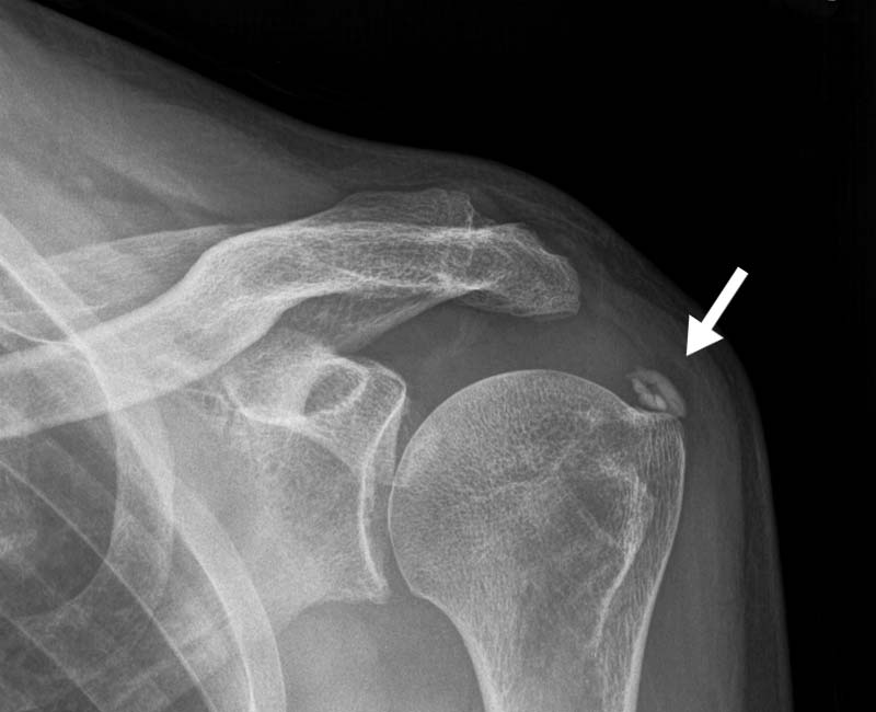 A calcium deposit, or calcification, in your shoulder may cause pain, but it may have no symptoms. Rather, it may show up on an imaging test for an unrelated condition.