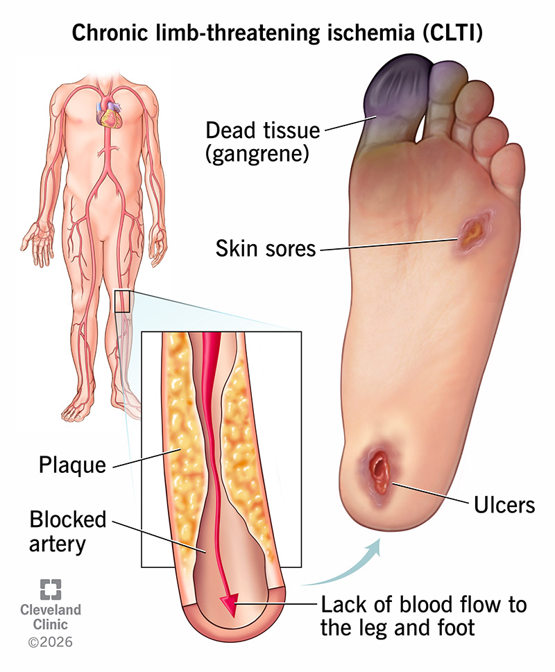 Illustration of gangrene and ulcers on the foot, which are signs of chronic limb-threatening ischemia