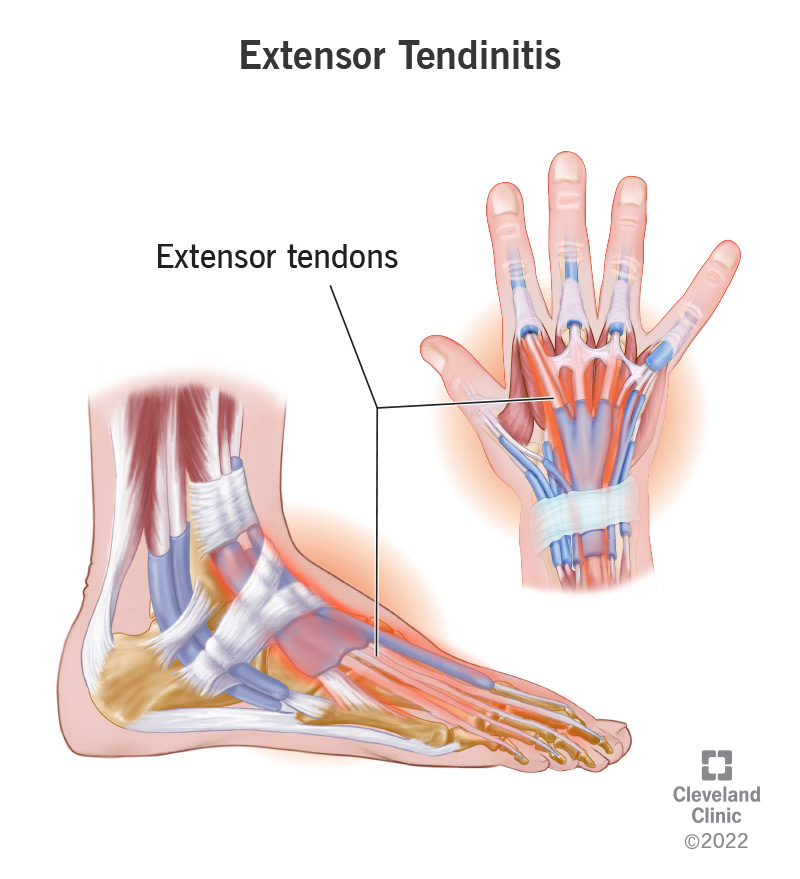 Extensor tendinitis labled on a hand and a foot.