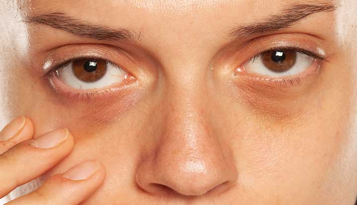 Dark circles under your eyes means the area of skin below your eyes looks darkened. This area may appear different shades of blue, purple, brown or black.
