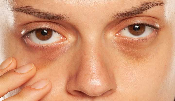 https://my.clevelandclinic.org/-/scassets/images/org/health/articles/23128-dark-circles-under-eyes