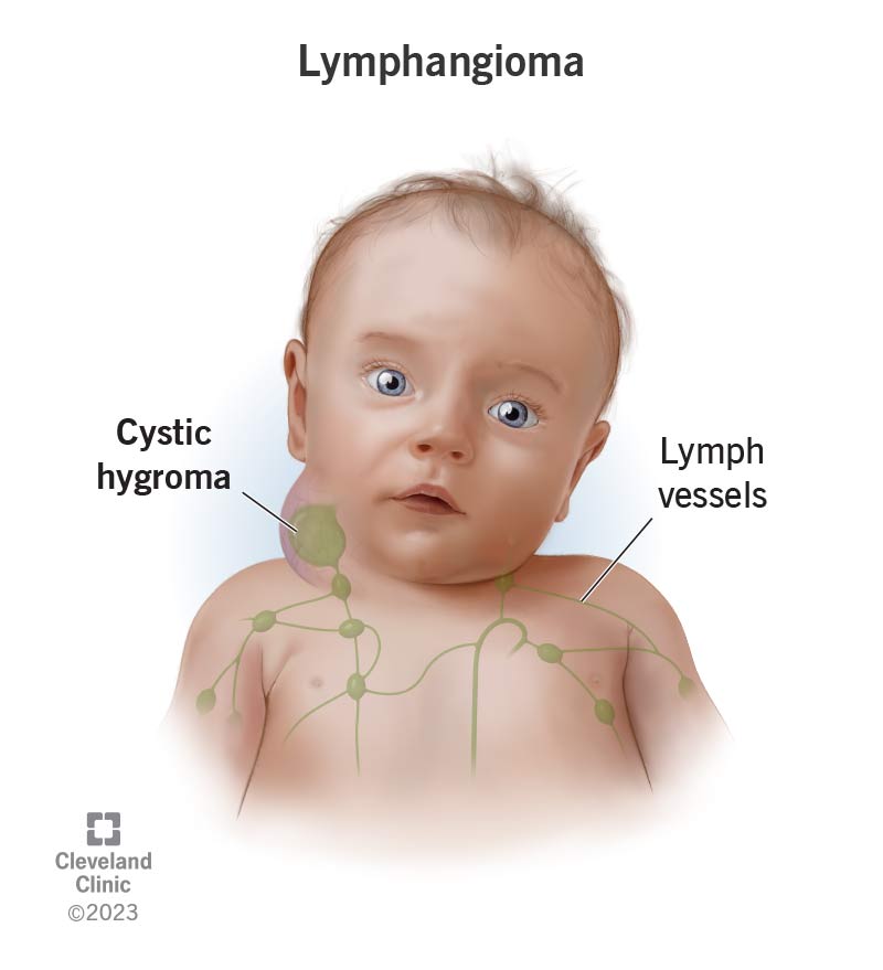 A baby that has a lymphangioma on its neck, with lymph vessels illustrated on its upper body.