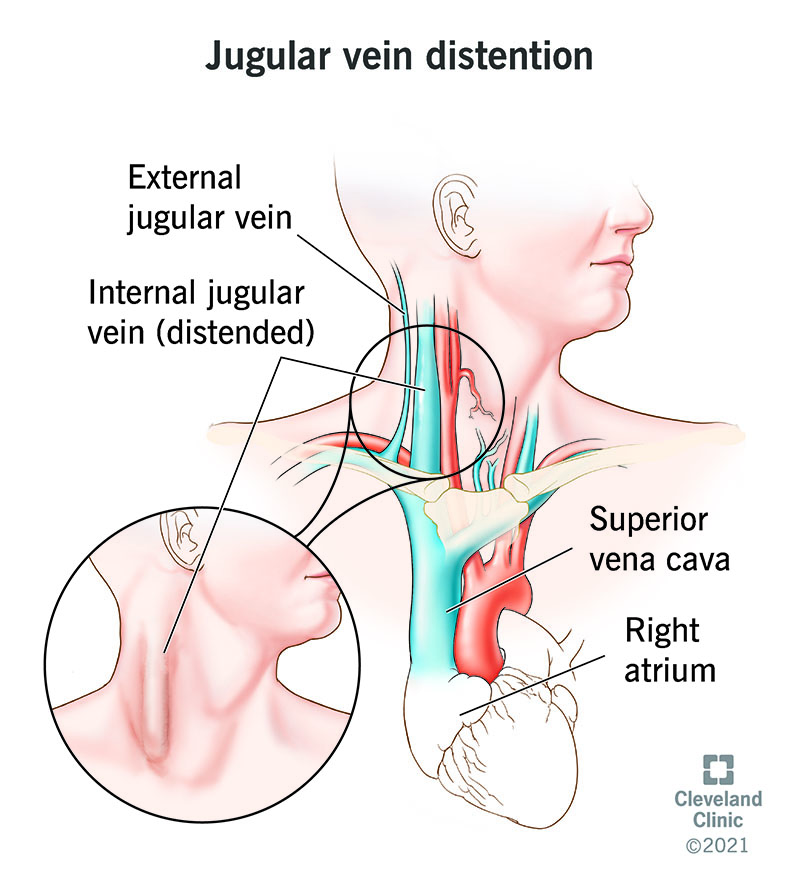 Swelling in your internal jugular vein causes a visible bulge on the side of your neck.