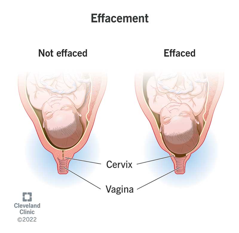 A fetus inside a uterus with a fully-effaced cervix and a fetus inside a uterus with a cervix that isn't effaced.