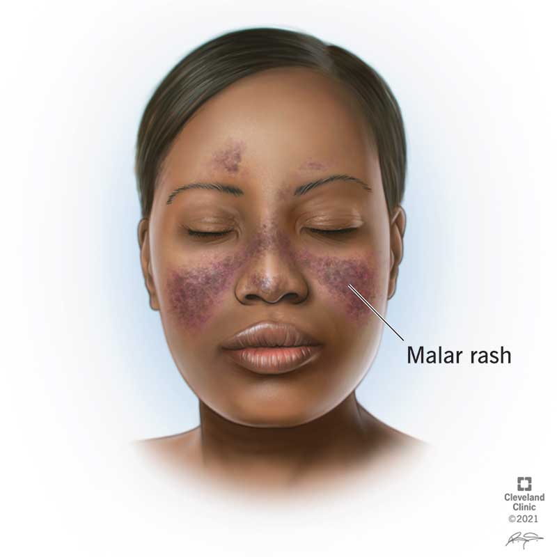Raised, purple lupus rash visible on both cheeks, across the nose and eyebrows on Black woman.